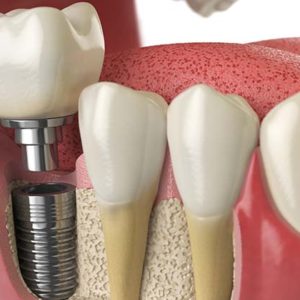 Implantes dentales Implantes dentales