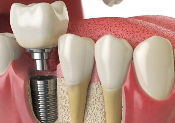 Implantes dentales