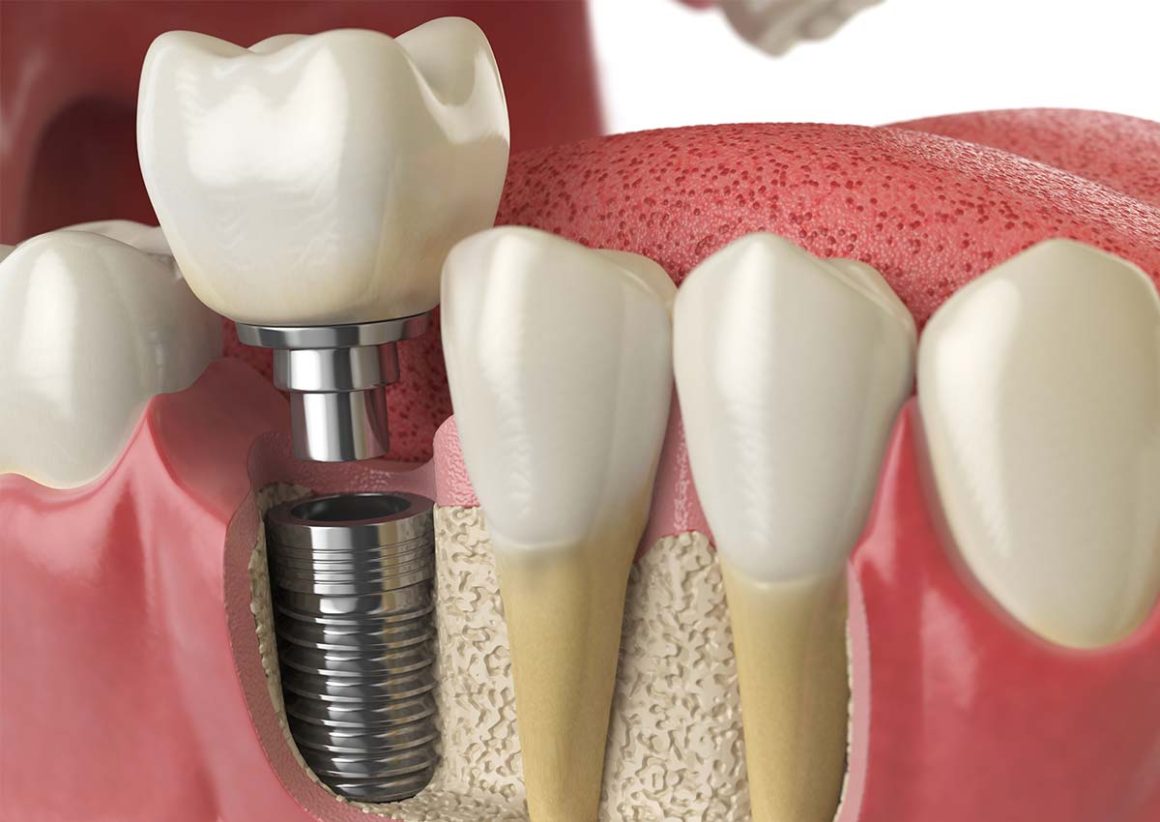 Implantes dentales